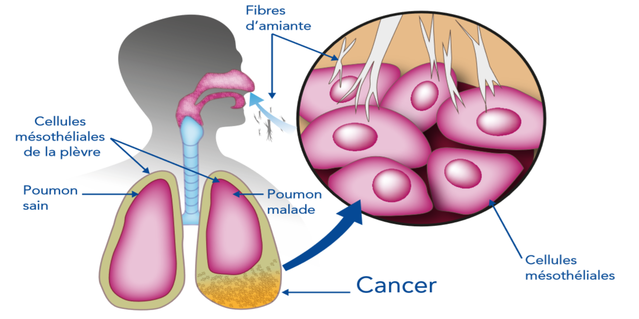 mésothéliome1